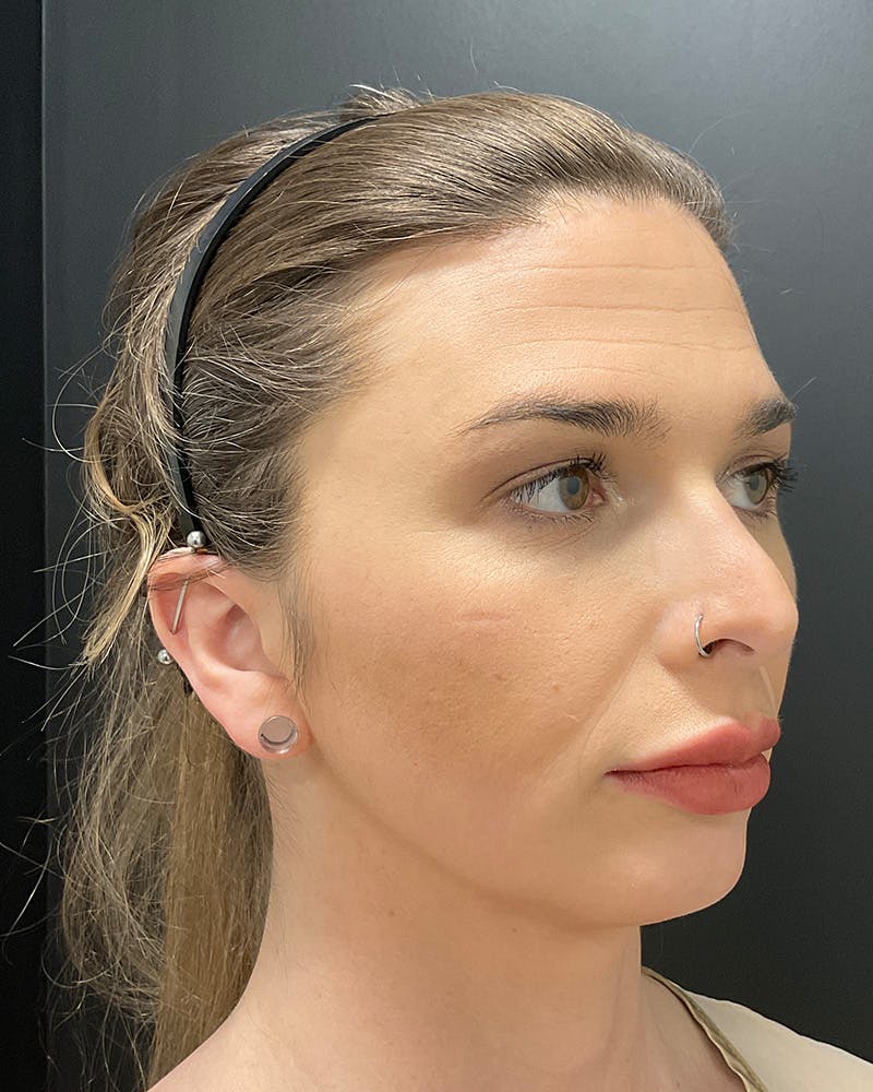 Facial Feminization Before & After Gallery - Patient 342426 - Image 4