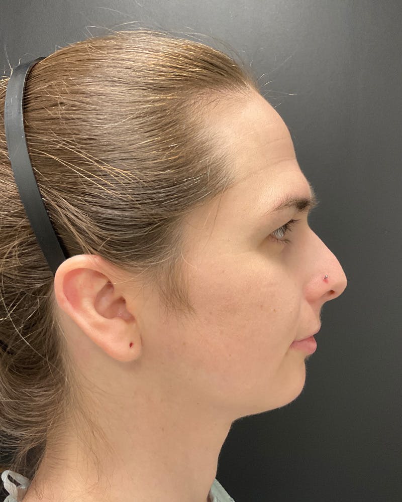 Facial Feminization Before & After Gallery - Patient 342426 - Image 5