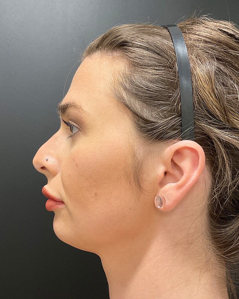 Facial Feminization Before & After Gallery - Patient 342426 - Image 10