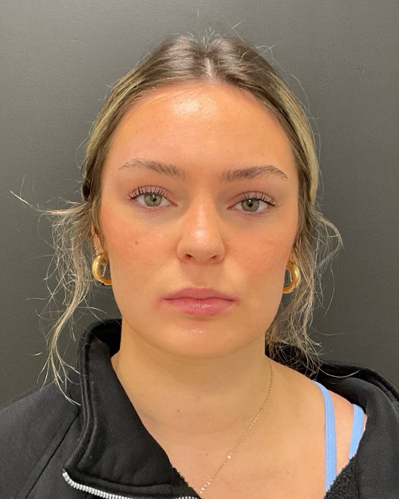 Injectables Before & After Gallery - Patient 377193 - Image 1