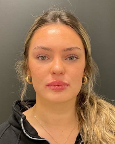 Injectables Before & After Gallery - Patient 377193 - Image 2