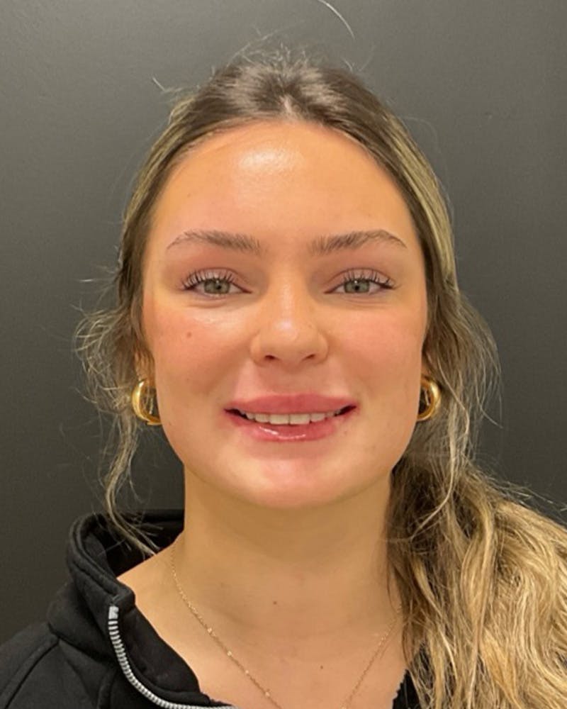 Injectables Before & After Gallery - Patient 377193 - Image 4