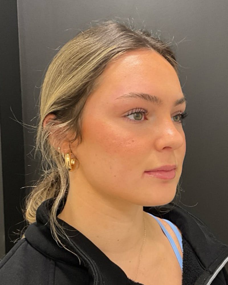 Injectables Before & After Gallery - Patient 377193 - Image 5