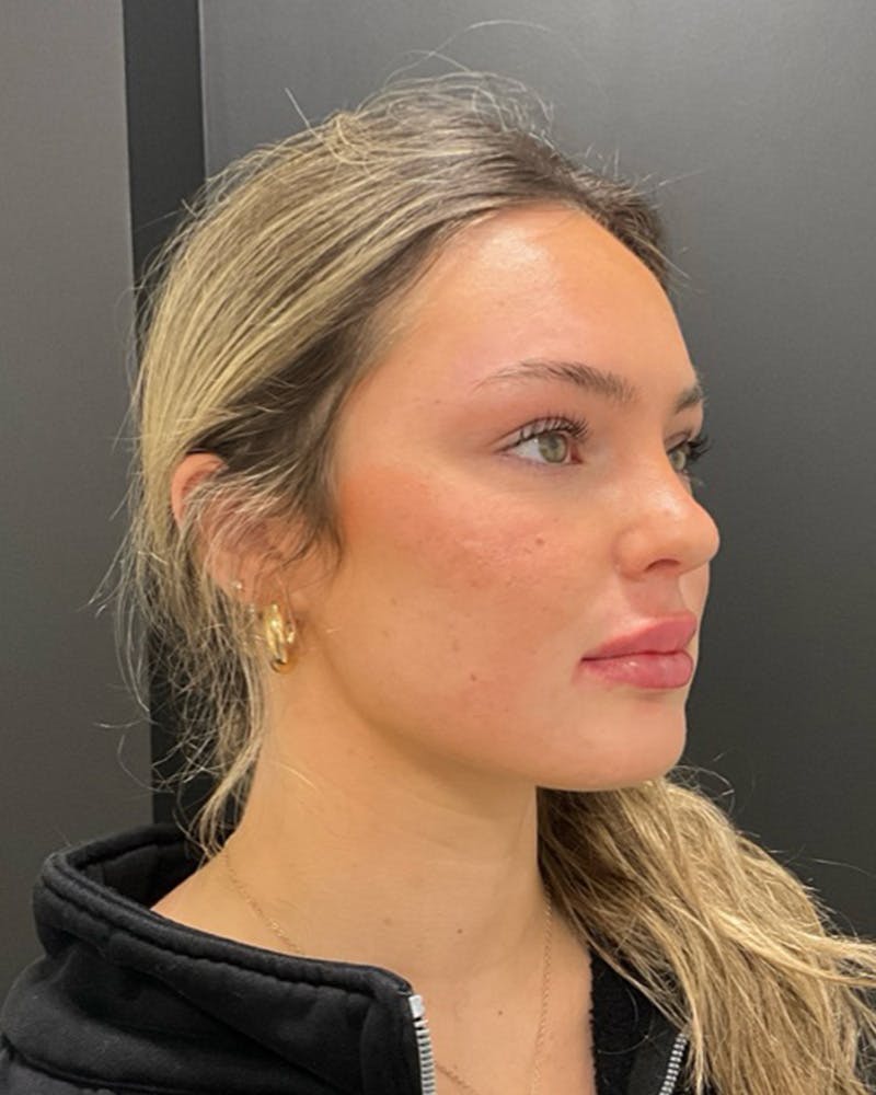 Injectables Before & After Gallery - Patient 377193 - Image 6