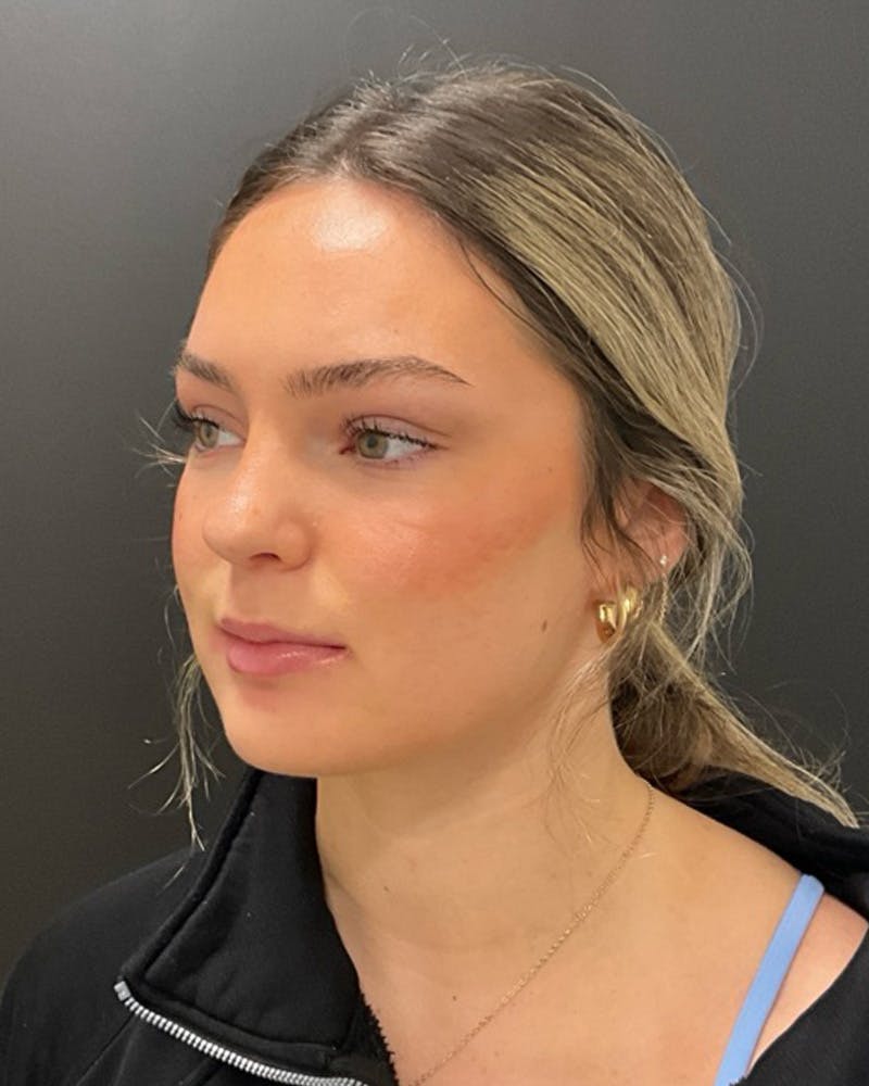 Injectables Before & After Gallery - Patient 377193 - Image 7