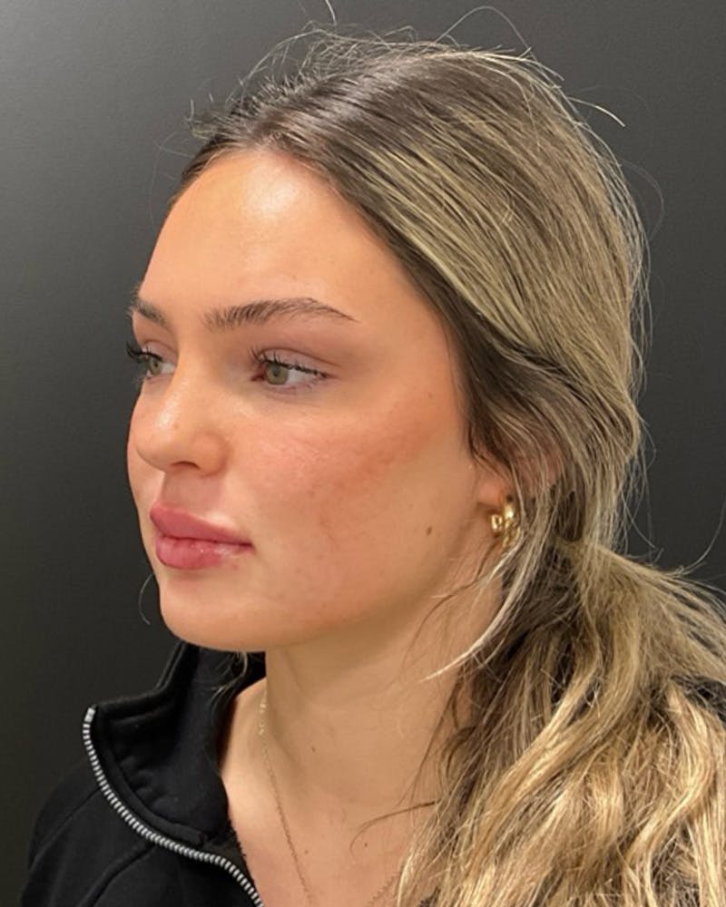 Injectables Before & After Gallery - Patient 377193 - Image 8