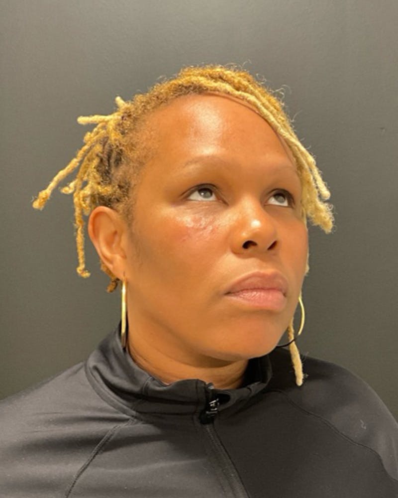 Injectables Before & After Gallery - Patient 249612 - Image 8