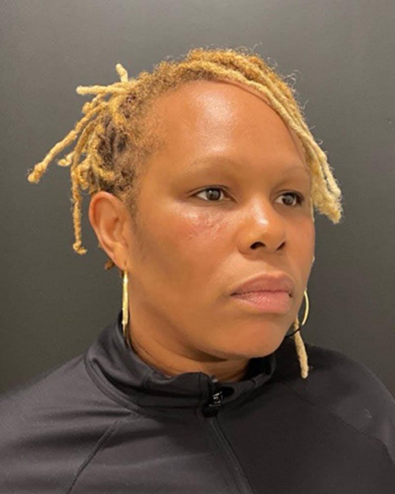 Injectables Before & After Gallery - Patient 249612 - Image 6