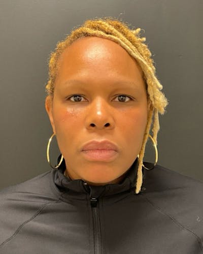 Injectables Before & After Gallery - Patient 249612 - Image 2