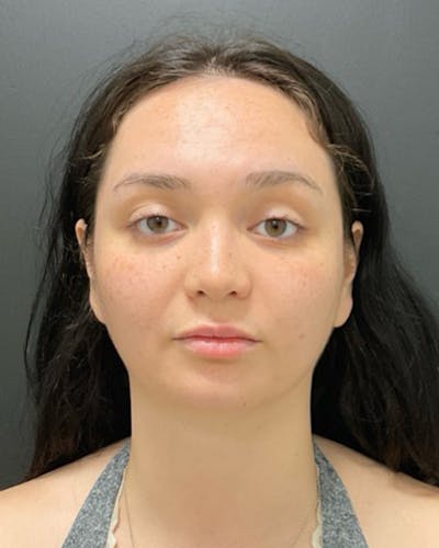 Injectables Before & After Gallery - Patient 352484 - Image 1