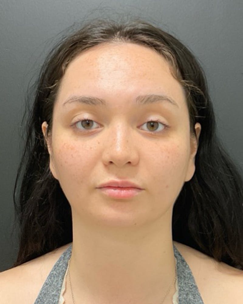 Injectables Before & After Gallery - Patient 352484 - Image 1