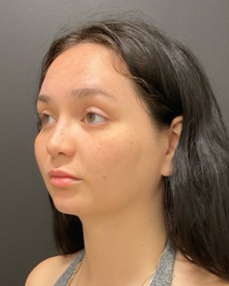 Injectables Before & After Gallery - Patient 352484 - Image 7