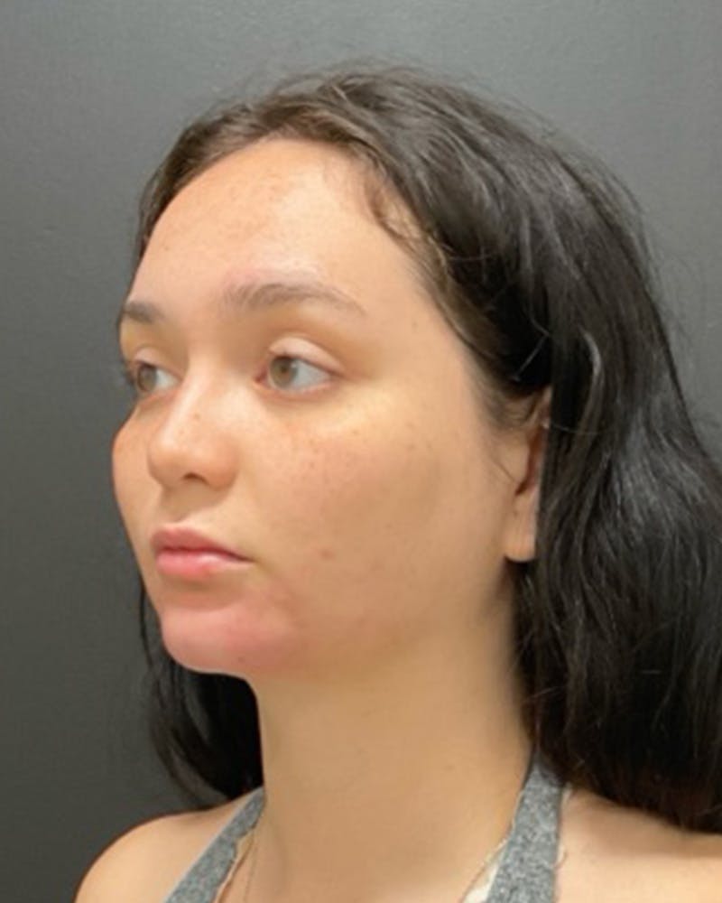 Injectables Before & After Gallery - Patient 352484 - Image 8