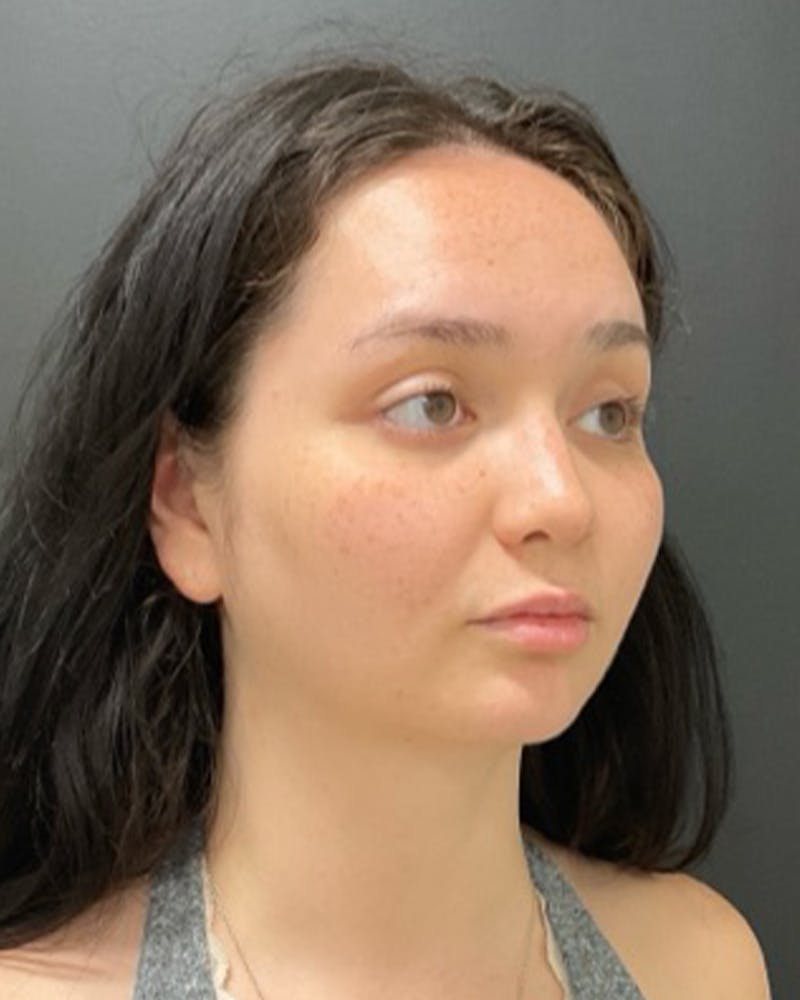 Injectables Before & After Gallery - Patient 352484 - Image 3