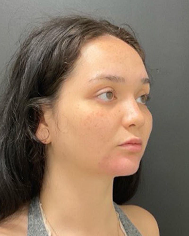 Injectables Before & After Gallery - Patient 352484 - Image 4