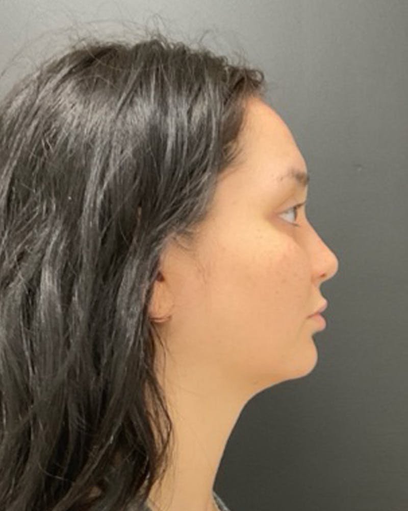 Injectables Before & After Gallery - Patient 352484 - Image 5