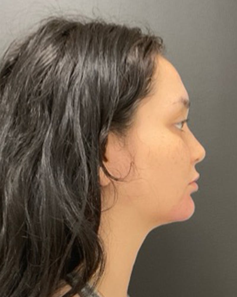 Injectables Before & After Gallery - Patient 352484 - Image 6