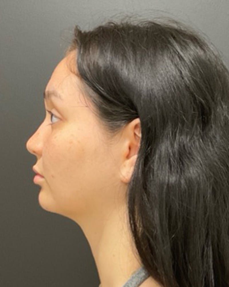 Injectables Before & After Gallery - Patient 352484 - Image 9