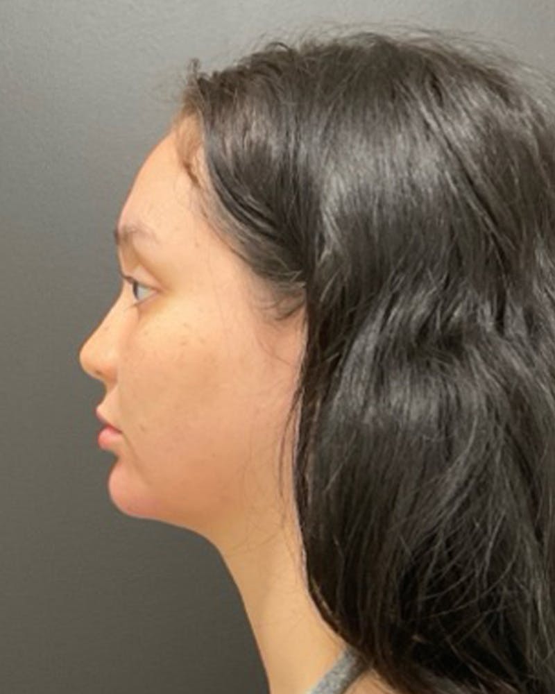 Injectables Before & After Gallery - Patient 352484 - Image 10