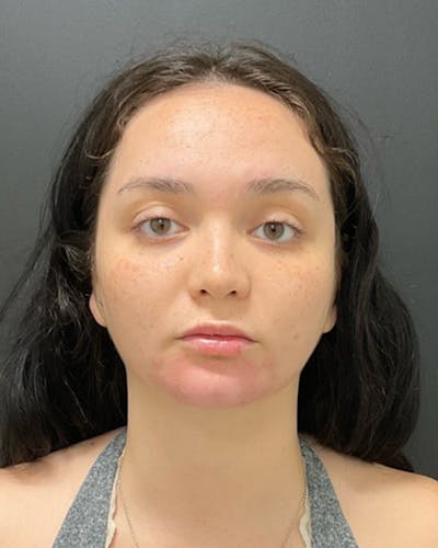 Injectables Before & After Gallery - Patient 352484 - Image 2