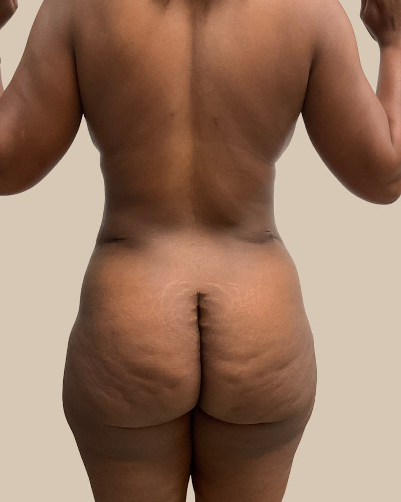 Mommy Makeover Before & After Gallery - Patient 404924 - Image 6