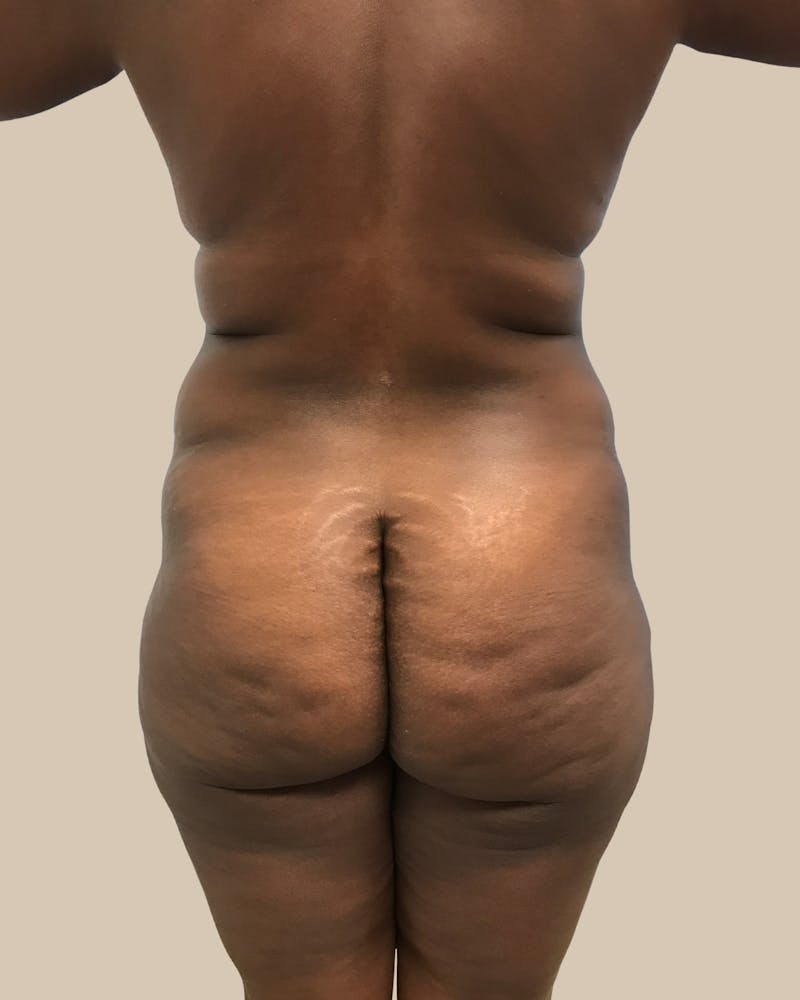 Mommy Makeover Before & After Gallery - Patient 404924 - Image 5