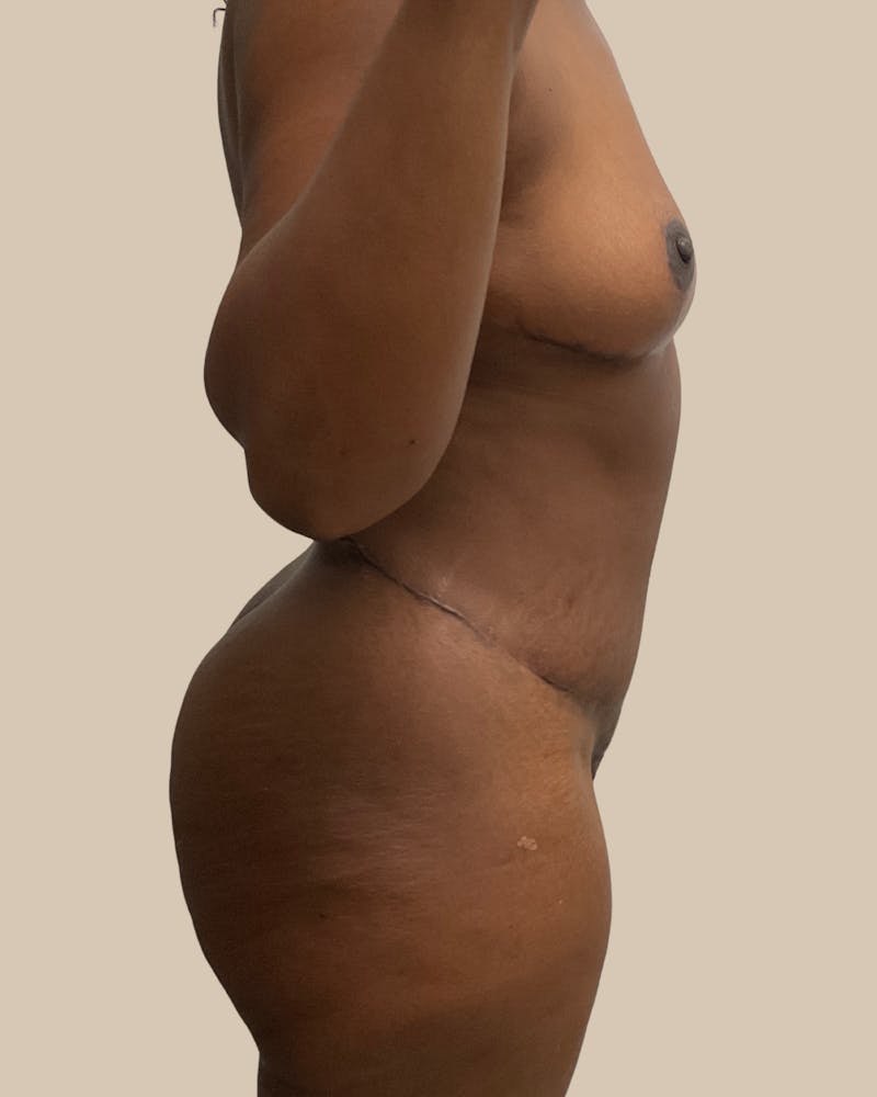 Mommy Makeover Before & After Gallery - Patient 404924 - Image 4