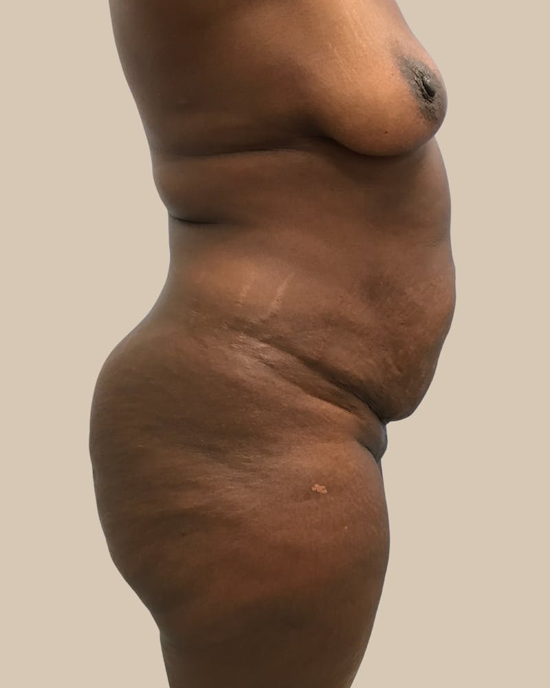 Mommy Makeover Before & After Gallery - Patient 404924 - Image 3