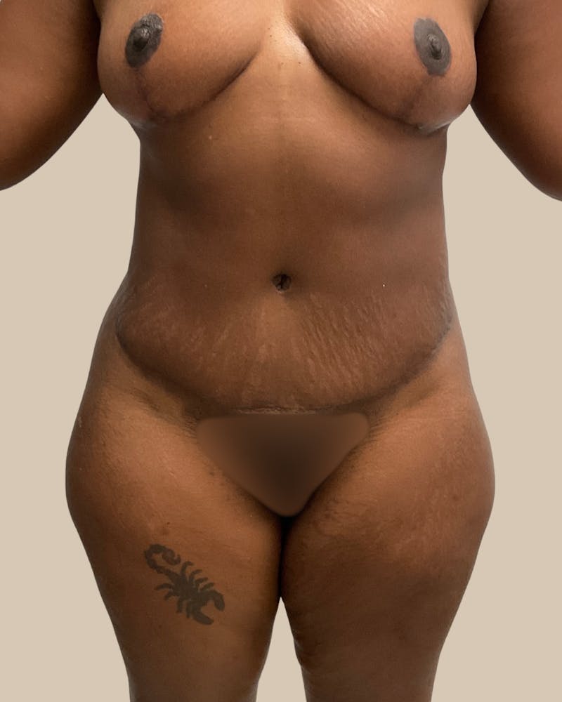 Mommy Makeover Before & After Gallery - Patient 404924 - Image 2