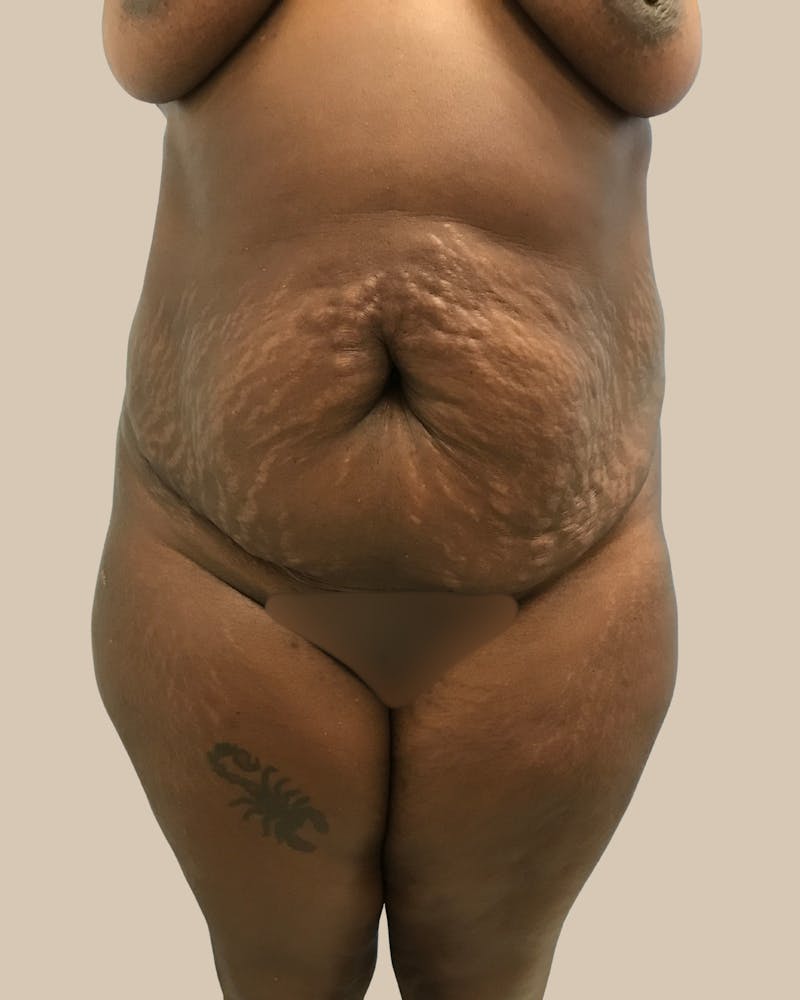 Mommy Makeover Before & After Gallery - Patient 404924 - Image 1