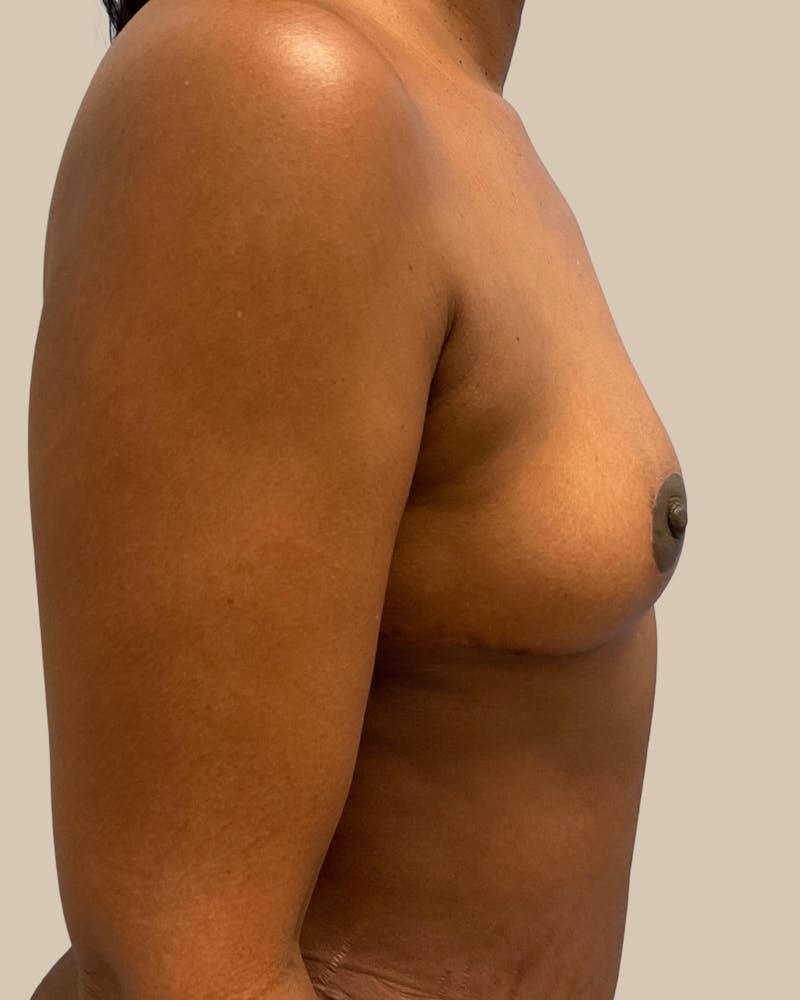 Mommy Makeover Before & After Gallery - Patient 404924 - Image 10