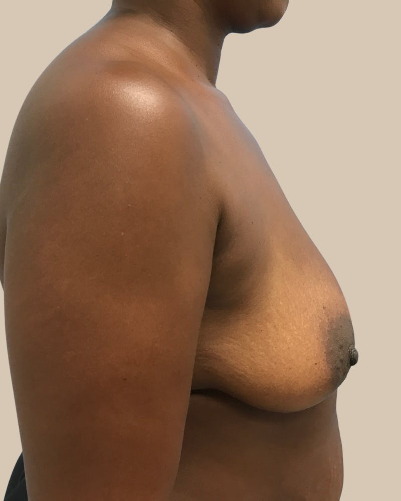 Mommy Makeover Before & After Gallery - Patient 404924 - Image 9