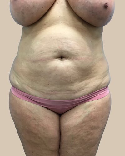 Mommy Makeover Before & After Gallery - Patient 347471 - Image 1