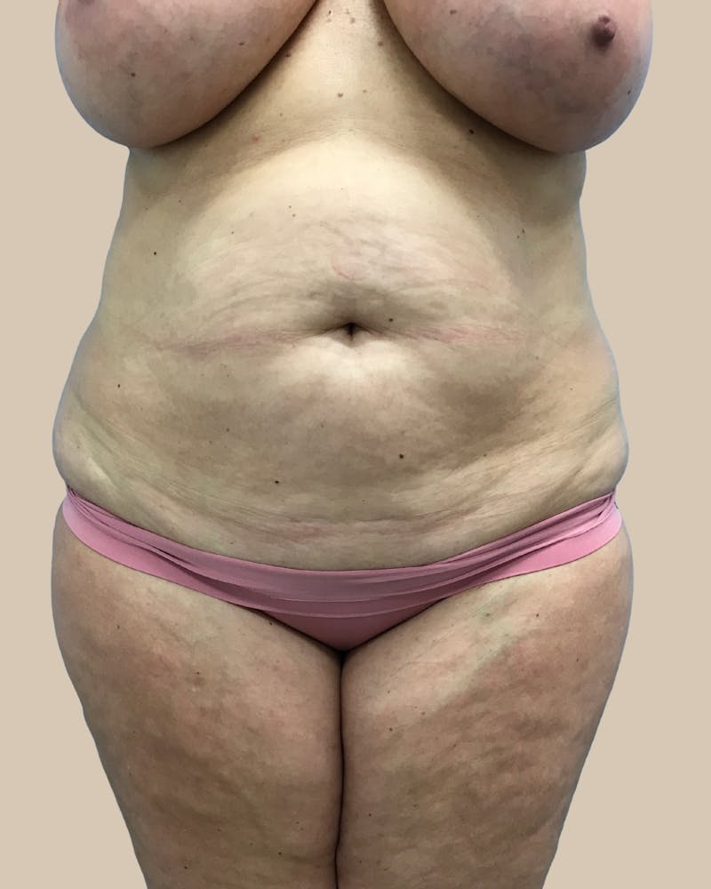Mommy Makeover Before & After Gallery - Patient 347471 - Image 1