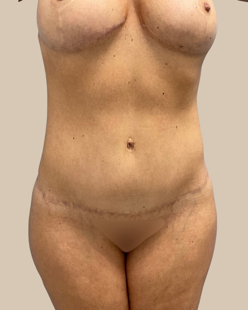Mommy Makeover Before & After Gallery - Patient 347471 - Image 2