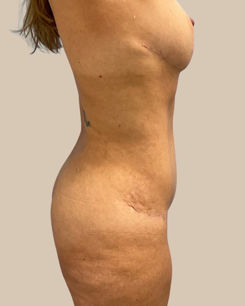 Mommy Makeover Before & After Gallery - Patient 347471 - Image 4