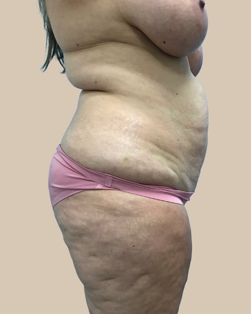 Mommy Makeover Before & After Gallery - Patient 347471 - Image 3
