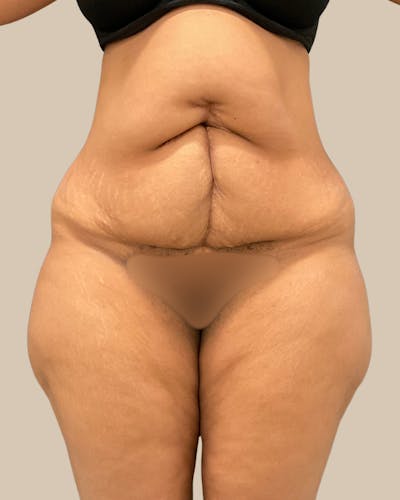 Tummy Tuck Before & After Gallery - Patient 518449 - Image 1