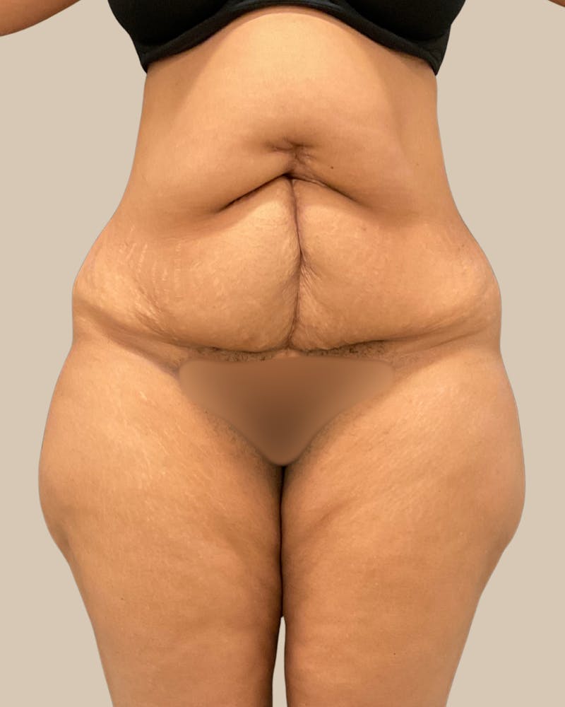 Tummy Tuck Before & After Gallery - Patient 518449 - Image 1