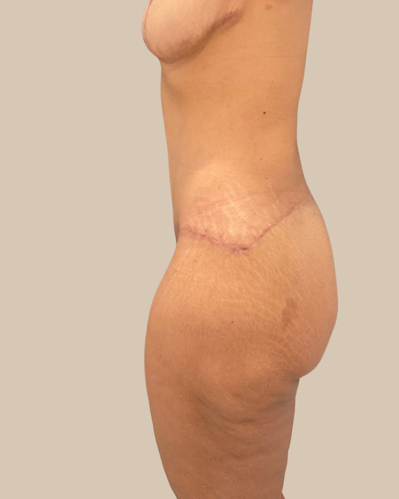 Tummy Tuck Before & After Gallery - Patient 518449 - Image 4