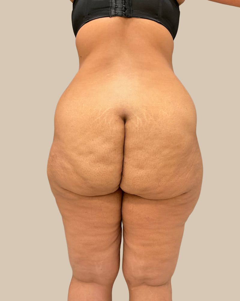 Tummy Tuck Before & After Gallery - Patient 518449 - Image 7