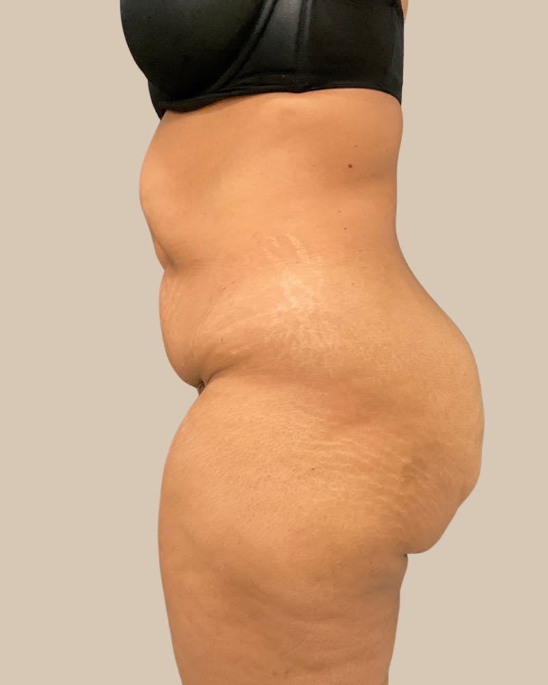 Tummy Tuck Before & After Gallery - Patient 518449 - Image 3