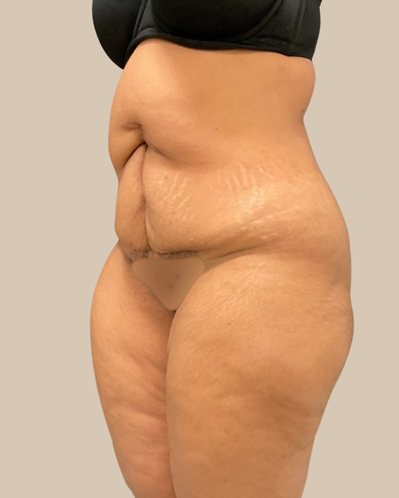Tummy Tuck Before & After Gallery - Patient 518449 - Image 5