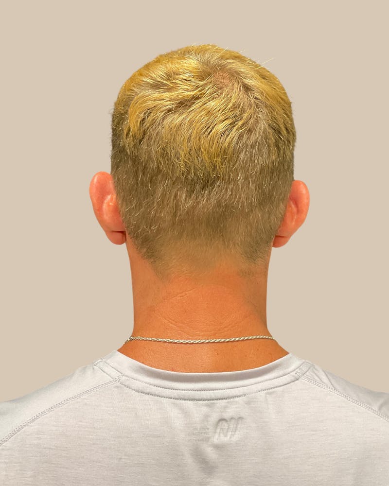 Otoplasty Before & After Gallery - Patient 999468 - Image 3