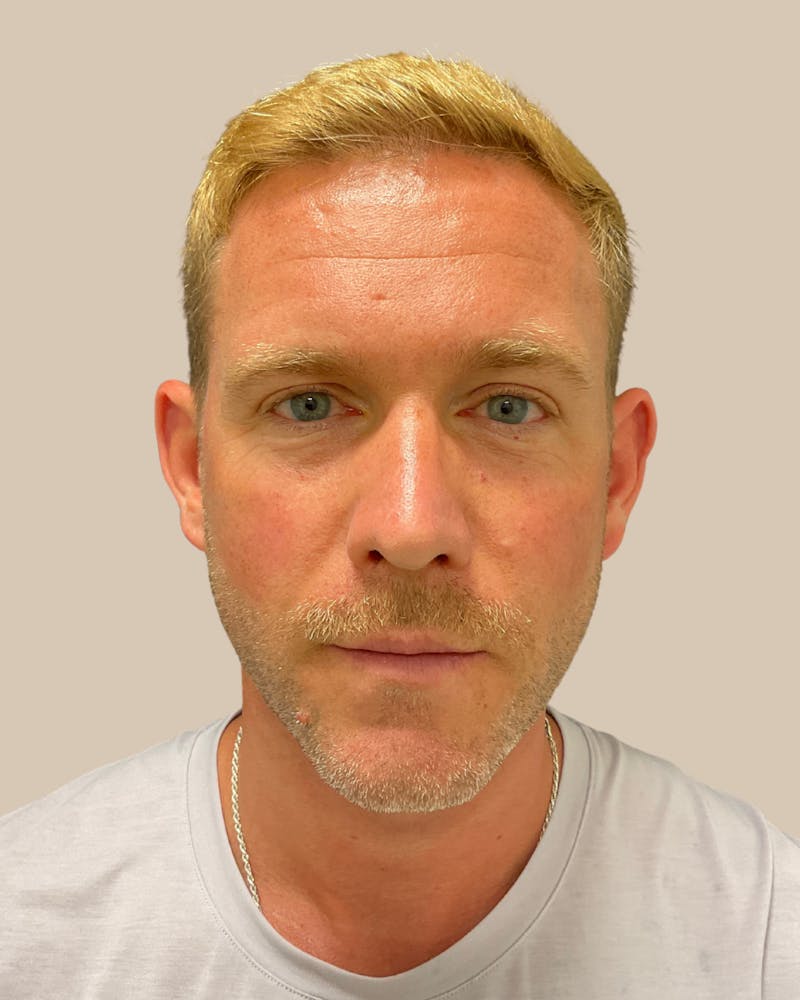 Otoplasty Before & After Gallery - Patient 999468 - Image 1
