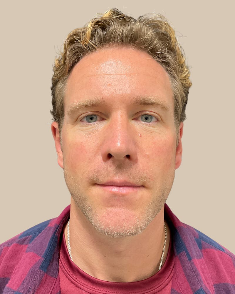 Otoplasty Before & After Gallery - Patient 999468 - Image 2