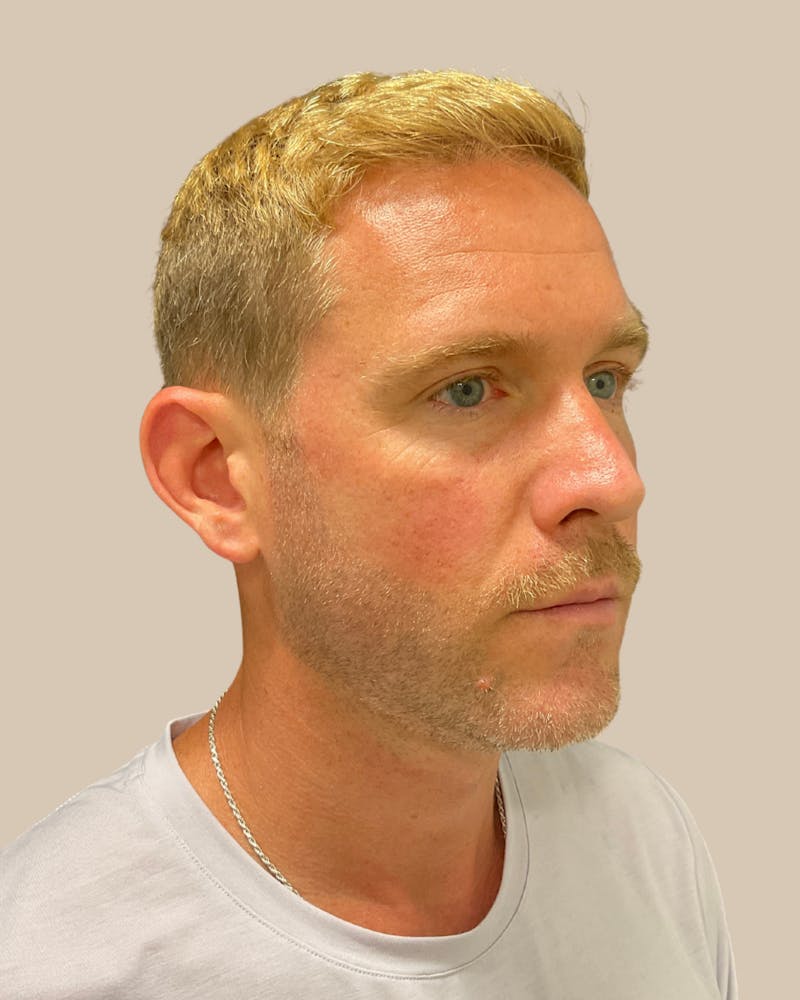Otoplasty Before & After Gallery - Patient 999468 - Image 5
