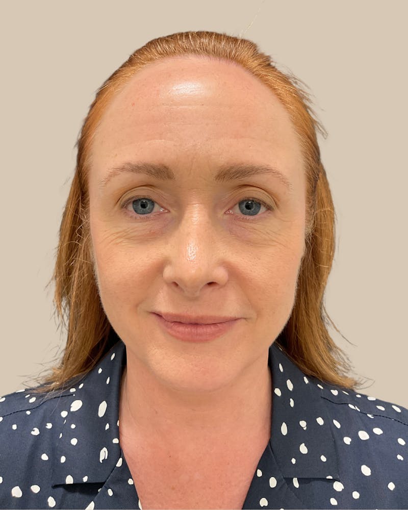 Forehead Reduction Before & After Gallery - Patient 175625 - Image 1