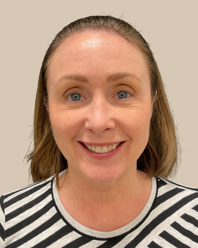 Forehead Reduction Before & After Gallery - Patient 175625 - Image 2