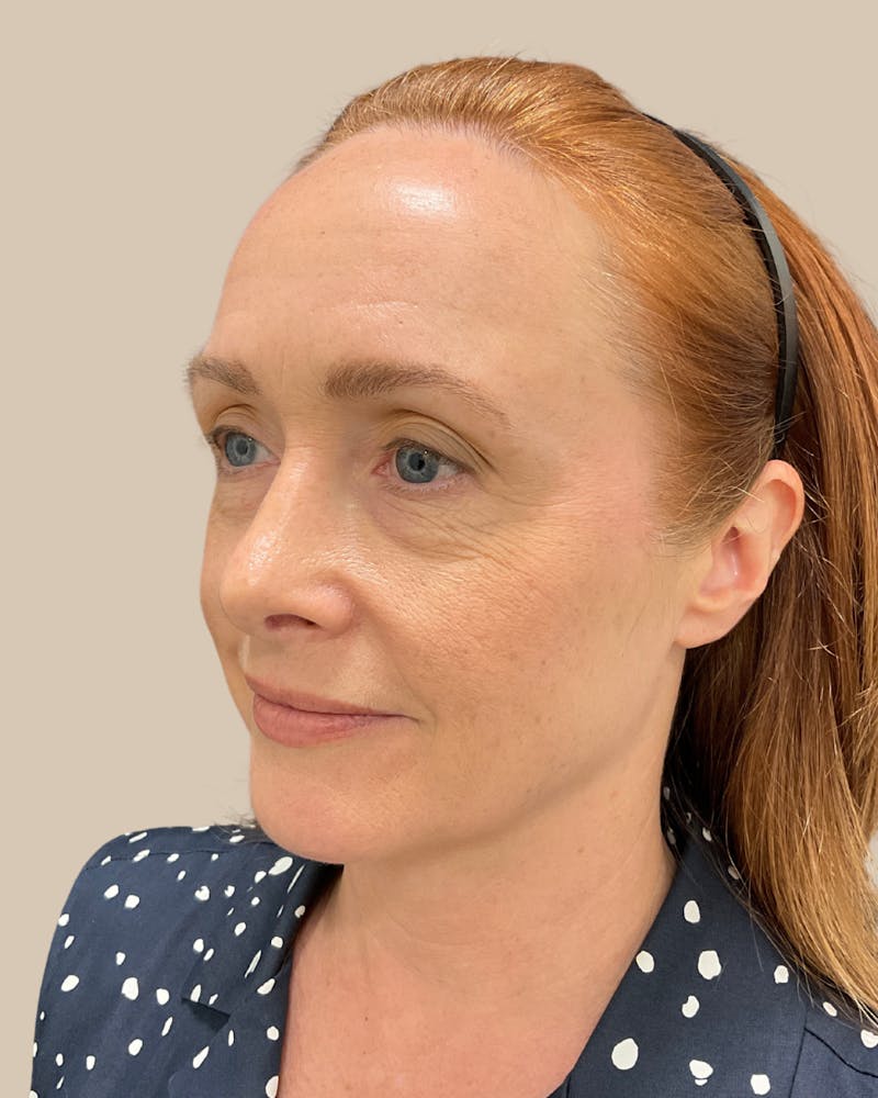 Forehead Reduction Before & After Gallery - Patient 175625 - Image 5